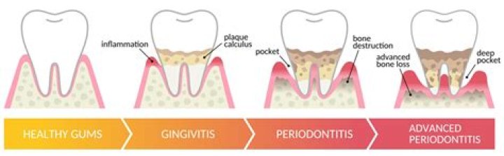 Can you shrink periodontal pockets?
