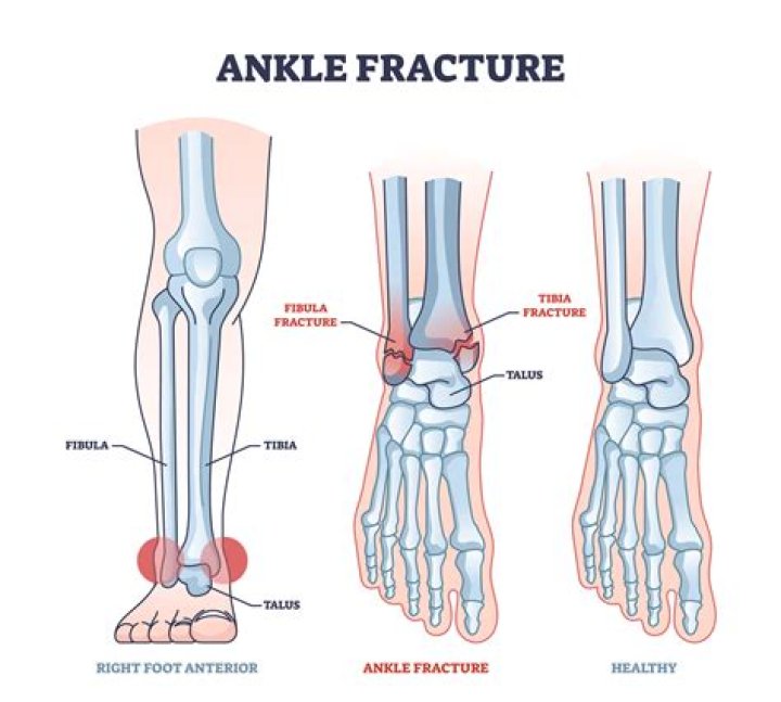 Can you swim with a fractured foot?