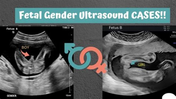 Can you tell if a baby is black or white in an ultrasound?