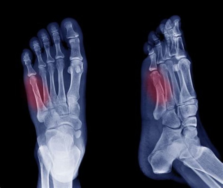 Can you walk on a fractured foot?