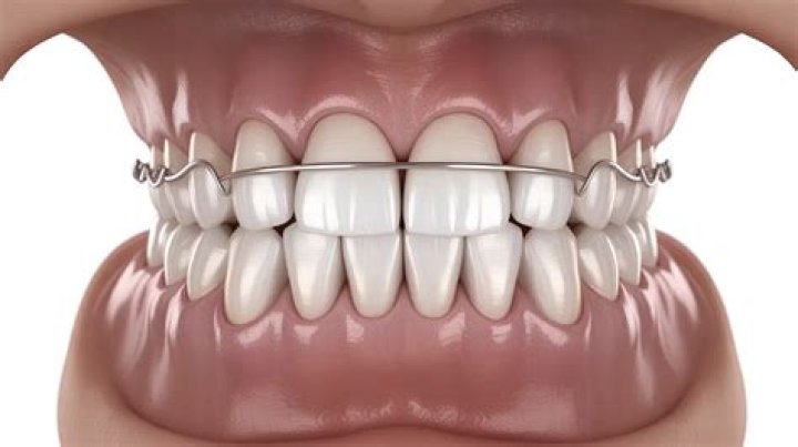 Can your teeth still shift with permanent retainers?
