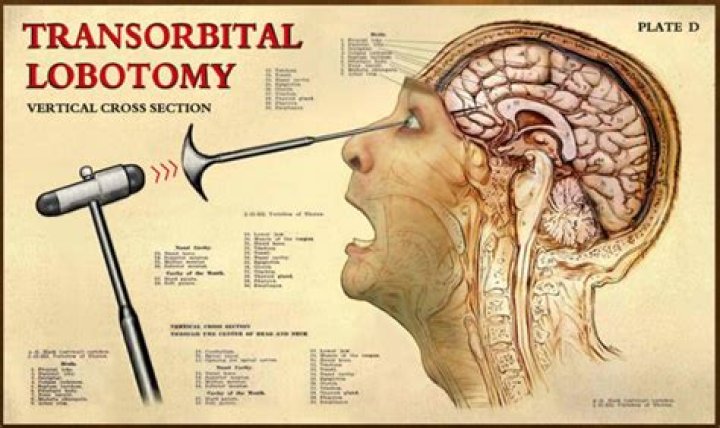 Did McMurphy get lobotomy?