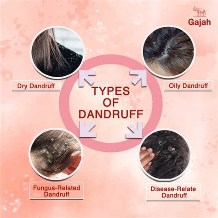 Do all races get dandruff?