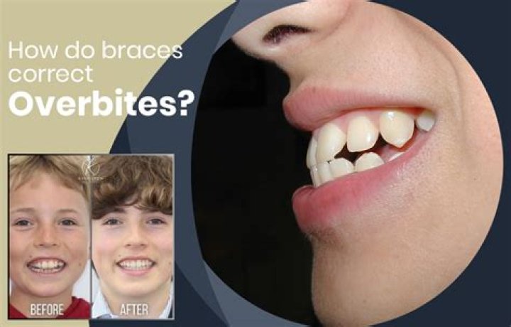 Do braces fix overbite?