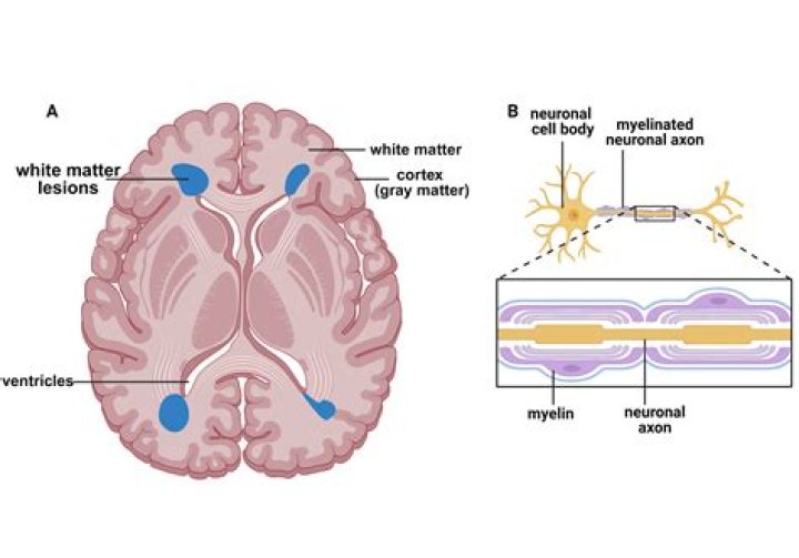 Do brain lesions always mean MS?