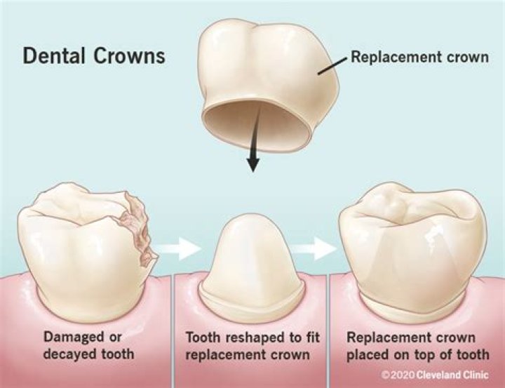 Do crowns feel weird at first?