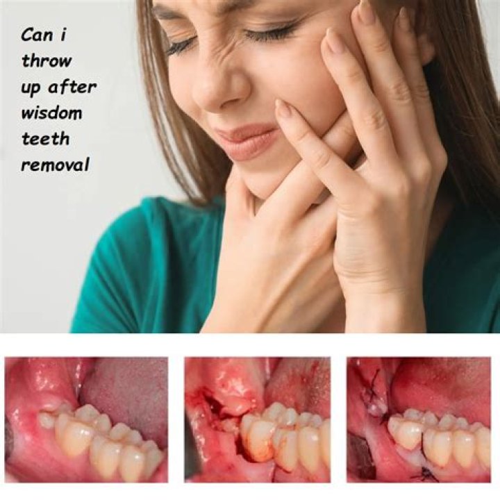 Do I need a ride home after wisdom teeth removal?