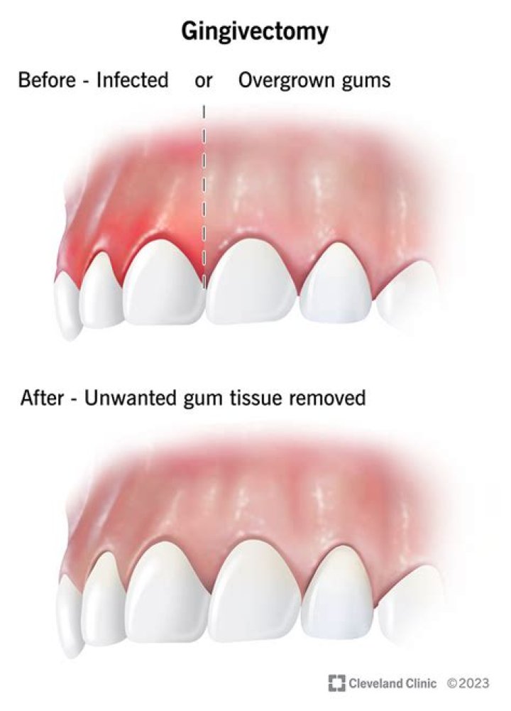Do I need surgery on my gums?