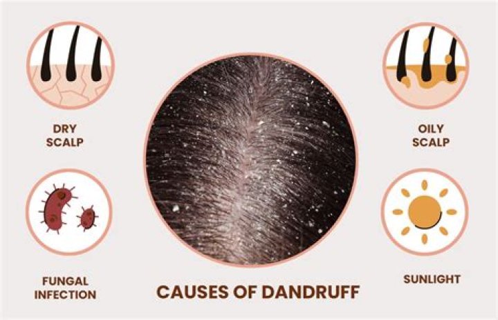 Do lice eat dandruff?