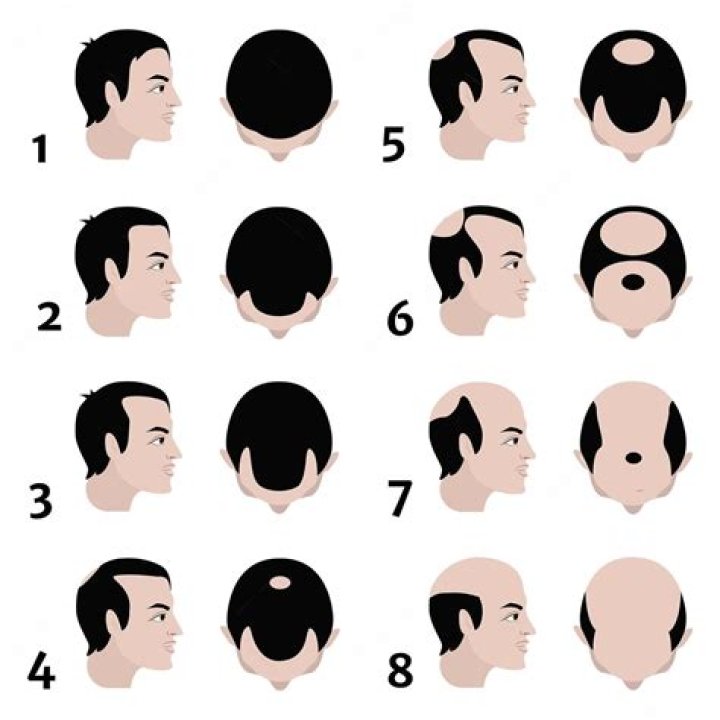 Do locs cause balding?