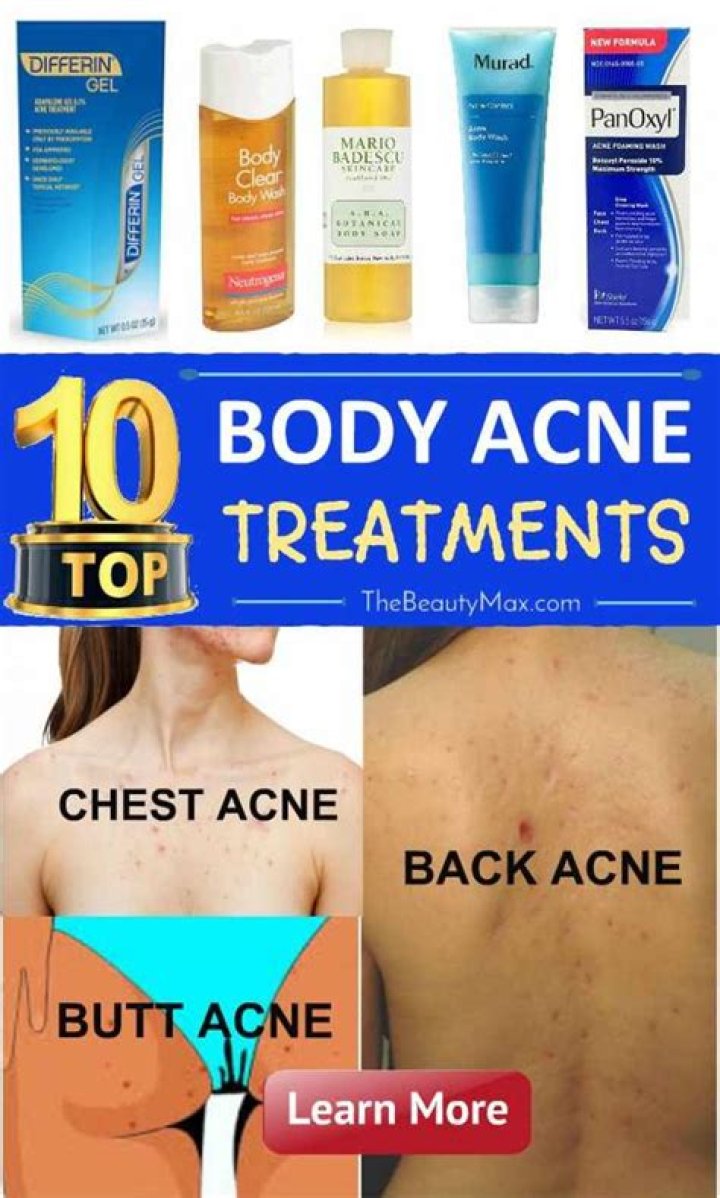 Do masseuses care about back acne?