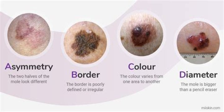 Do melanomas hurt?