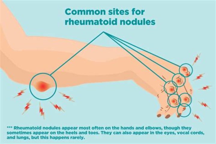 Do rheumatoid nodules burst?