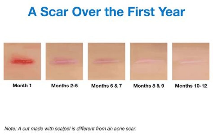 Do scars fade over time?