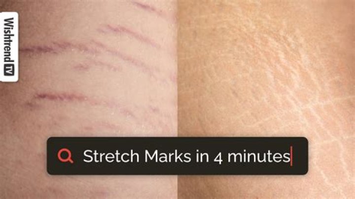 Do sit ups help stretch marks?