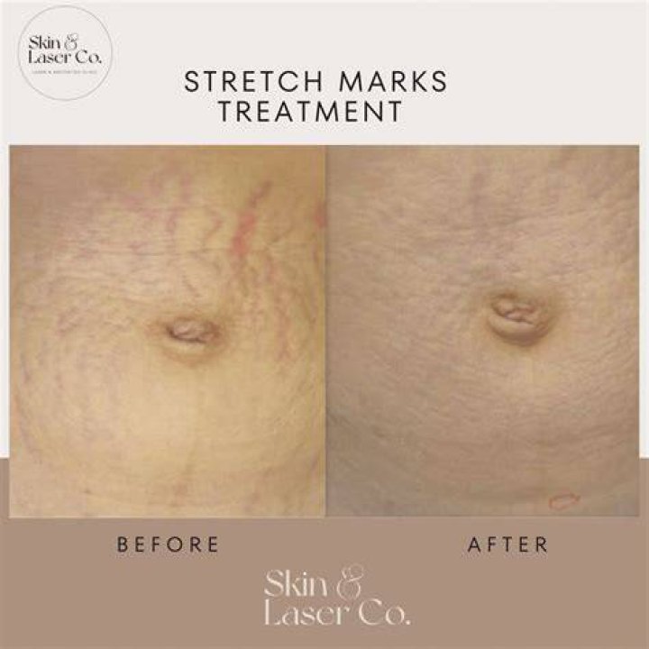 Do stretch marks eventually turn white?