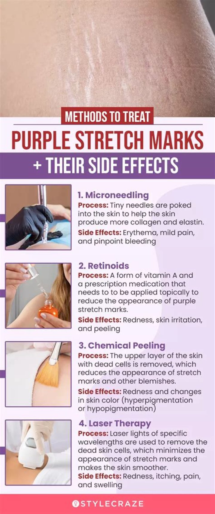 Do stretch marks stay purple?