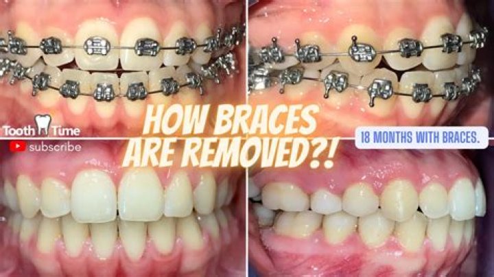 Do they shave teeth after braces?