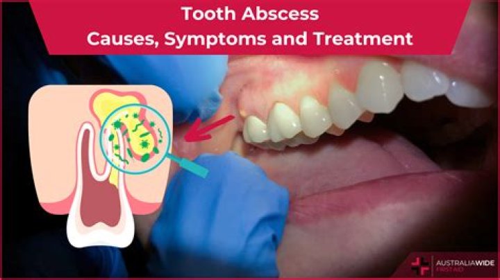 Does a tooth abscess bleed?