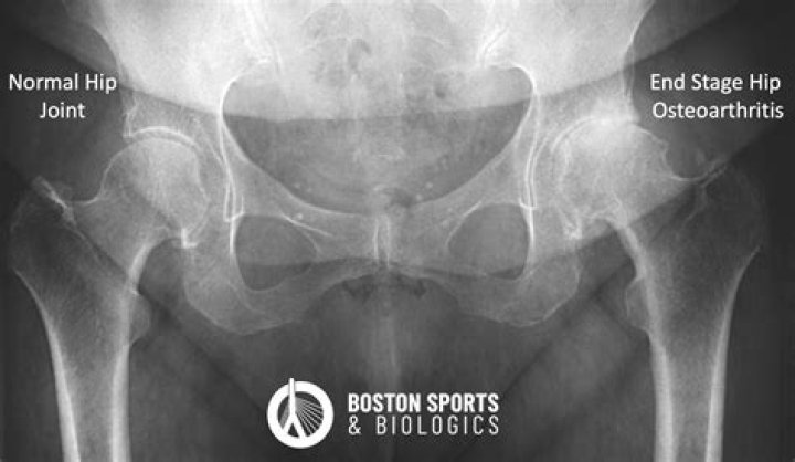Does arthritis show up on xray?
