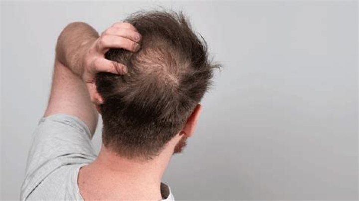Does coconut oil cause hairloss?
