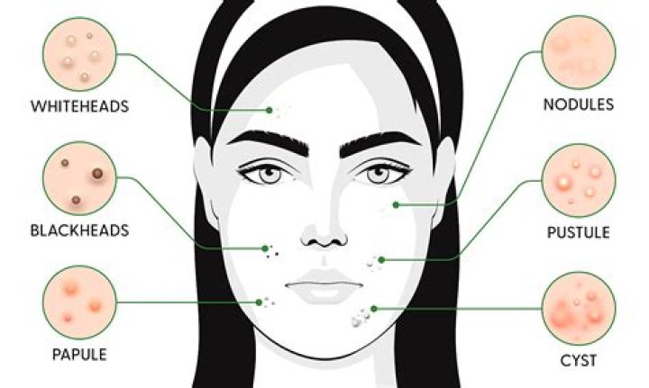 Does Coldwater cause acne?