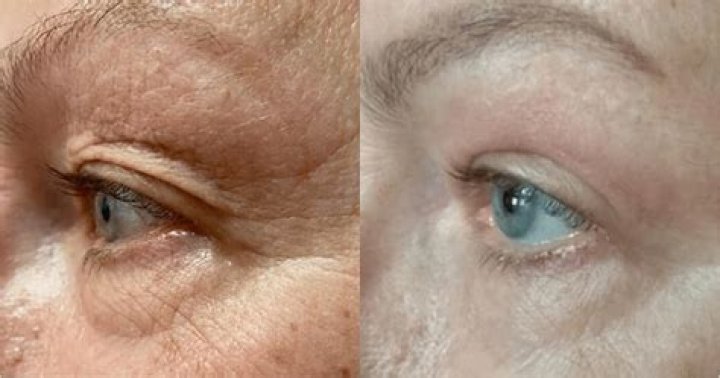 Does CoQ10 tighten skin?