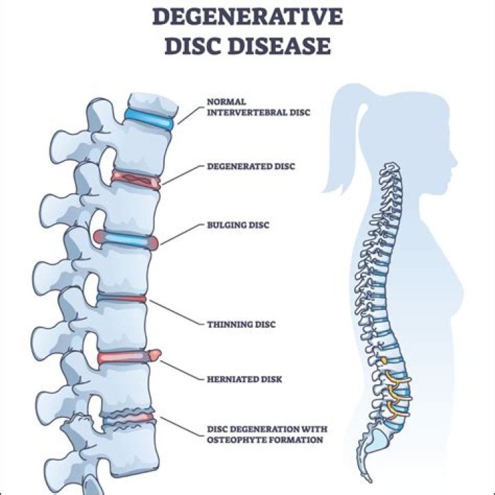 Does degenerative disc disease show on MRI?