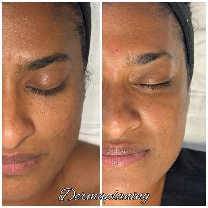 Does dermaplaning work for wrinkles?