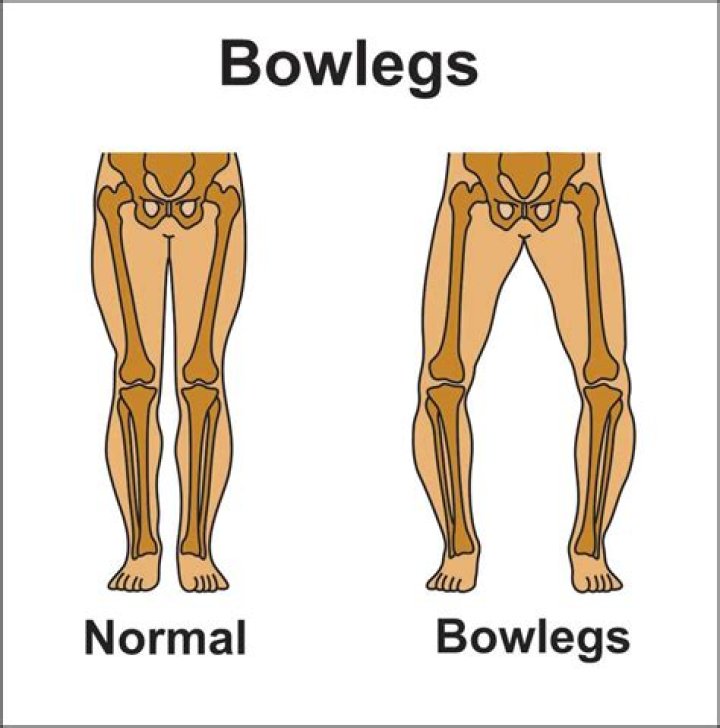 Does early walking cause bow legs?