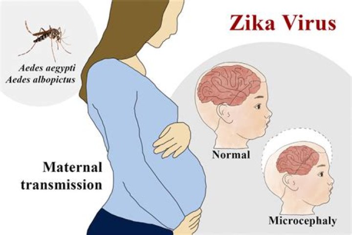 Does every pregnant woman with Zika have microcephaly?