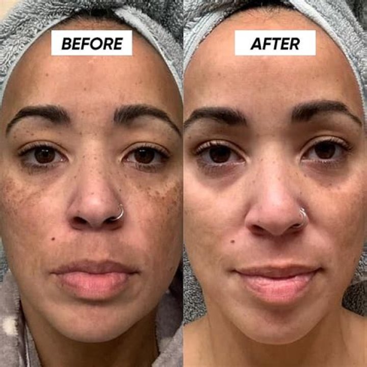 Does fake tan make spots look worse?