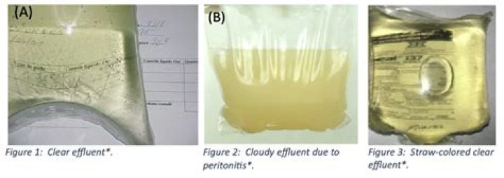 Does fibrin need to be removed?