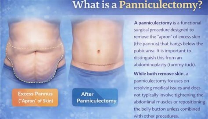 Does Florida blue cover Panniculectomy?
