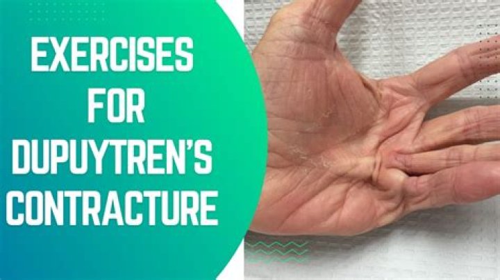 Does heat help Dupuytren's?