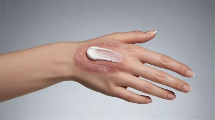 Does hydrocortisone help eczema?