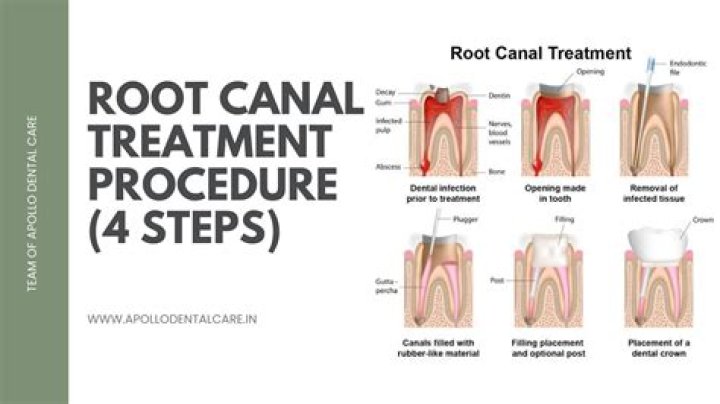Does it hurt to redo a root canal?