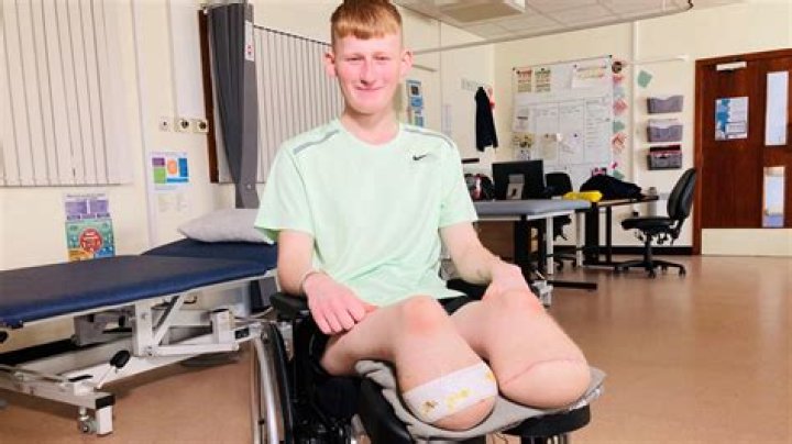 Does Jamie's leg get amputated?