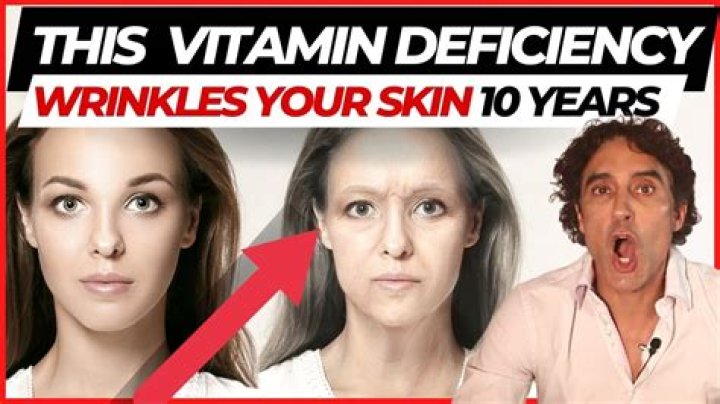 Does lack of vitamin D cause wrinkles?
