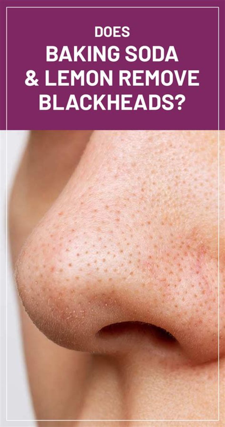 Does lemon and baking soda remove blackheads?