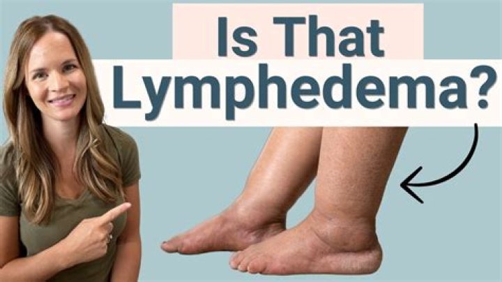 Does lymphedema ever go away?