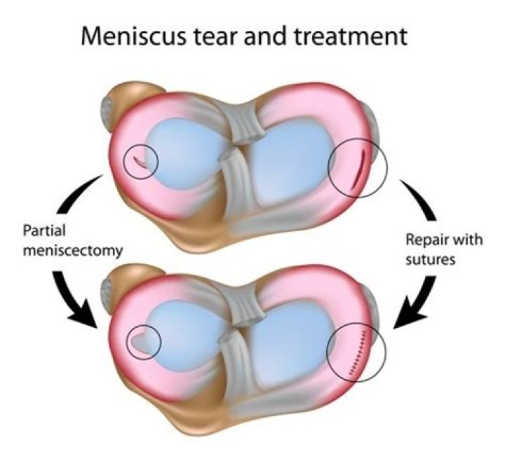 Does meniscus surgery lead to arthritis?