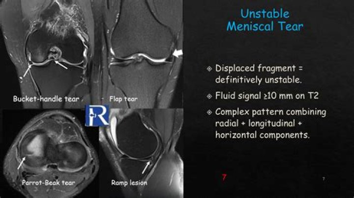 Does meniscus tear hurt to touch?