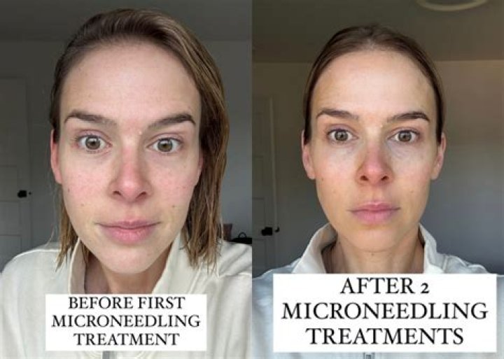 Does microneedling have long term effects?