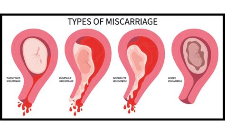 Does miscarriage hurt?