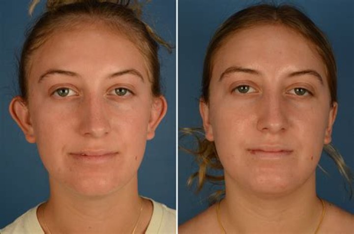 Does otoplasty affect hearing?
