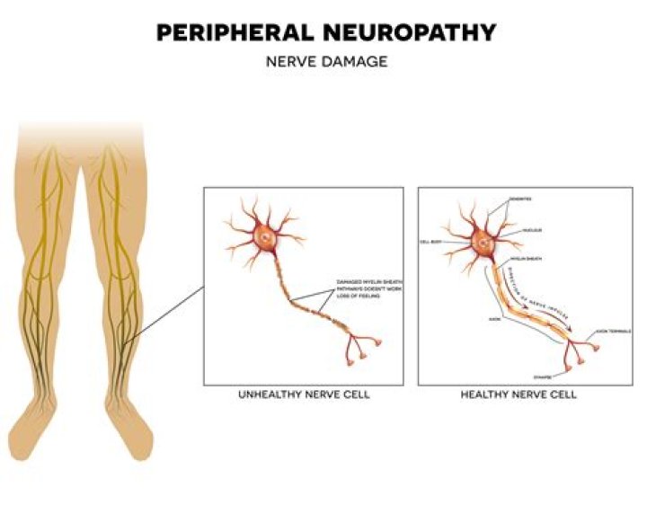 Does peripheral neuropathy show up on MRI?