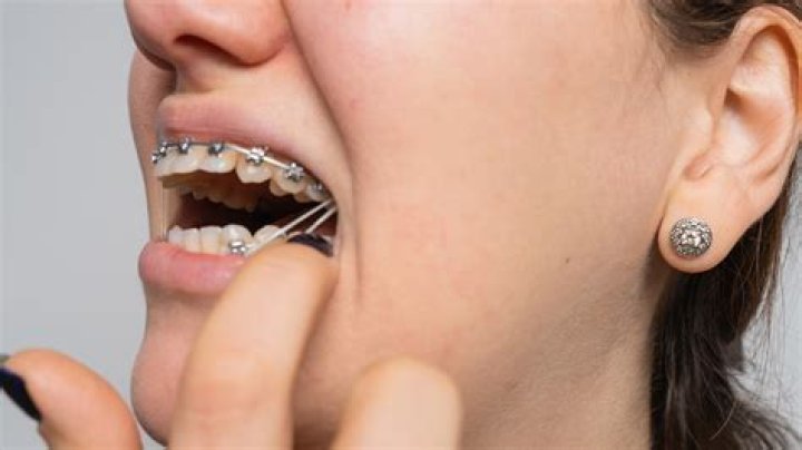 Does rubber bands mean braces are almost done?