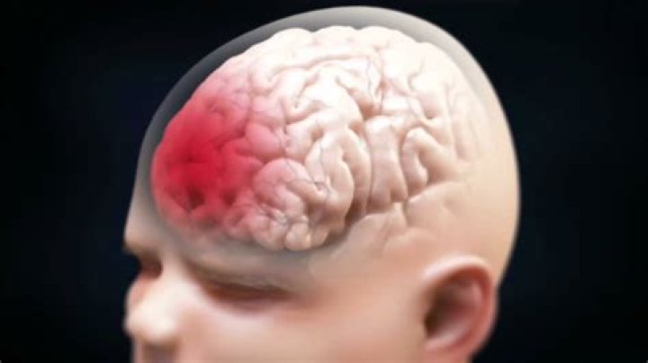 Does shaking your head cause brain damage?