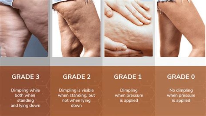 Does sitting too much cause cellulite?